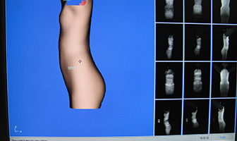 scoliosis_software
